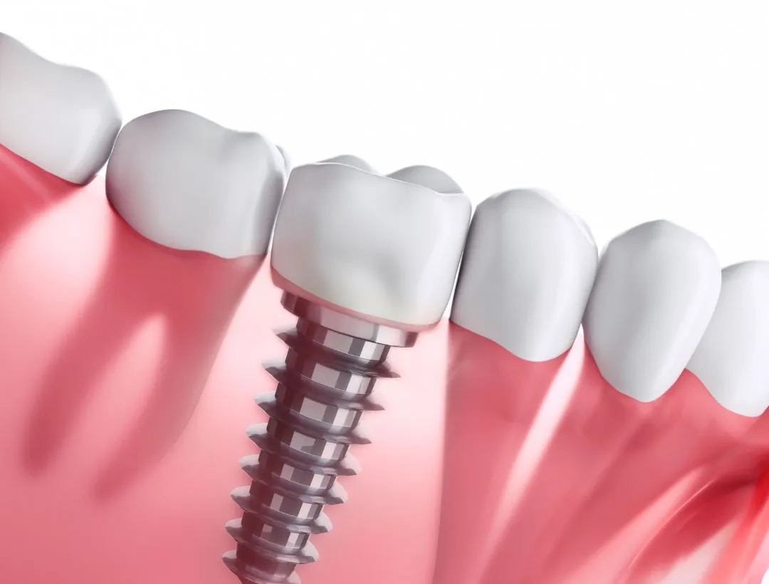 what to know about dental implants for seniors