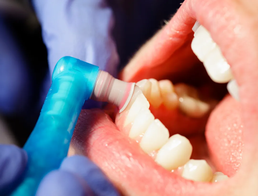 is deep cleaning necessary?