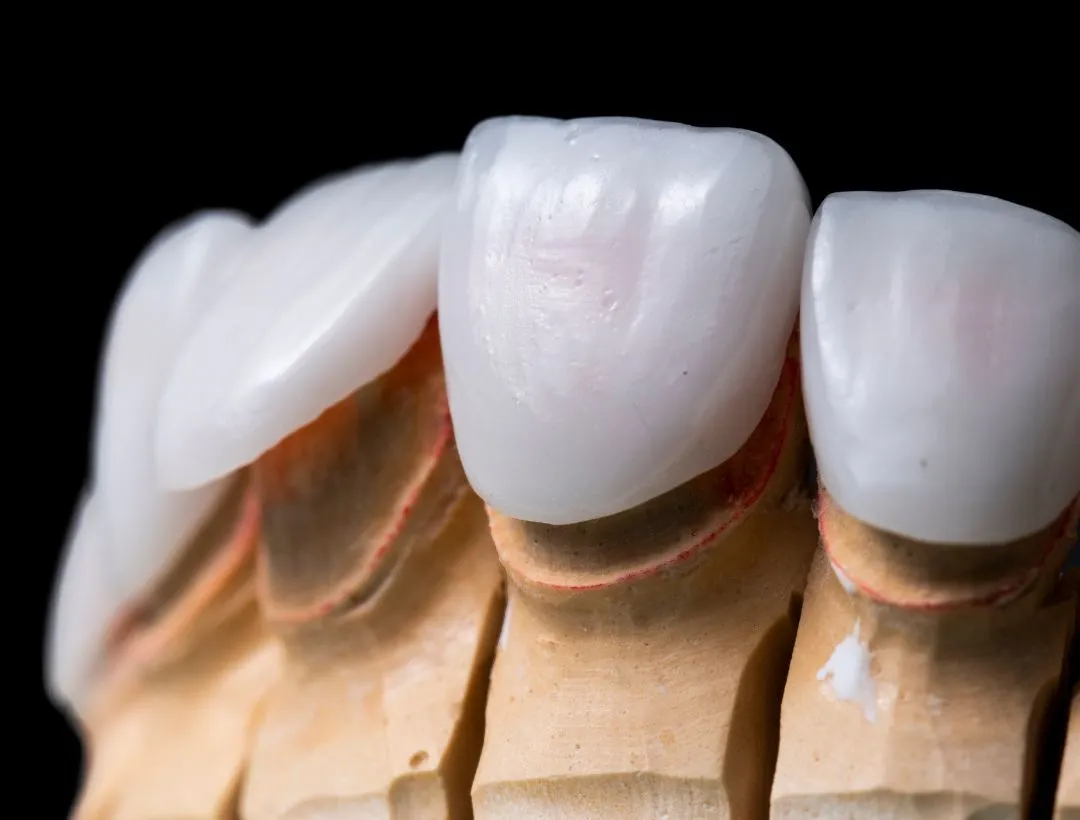 what causes porcelain veneers to fail?