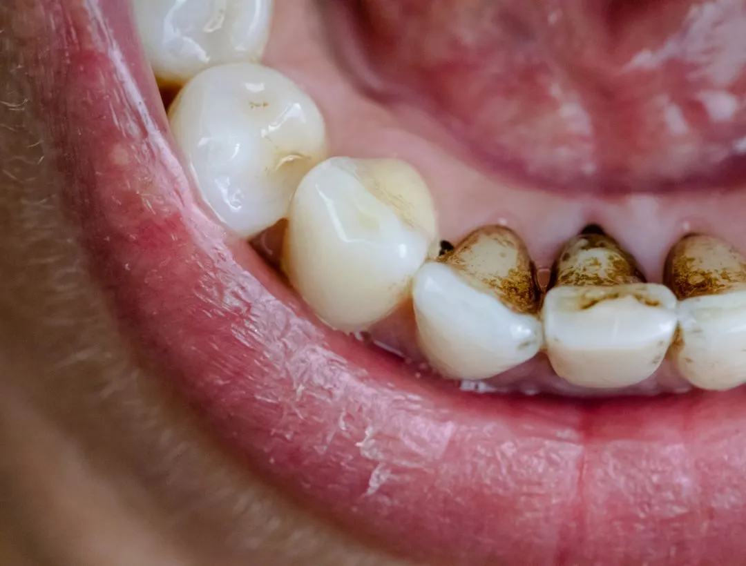 what it means if your tooth broke off and it&rsquo;s black inside