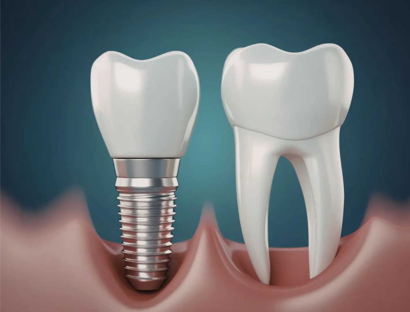 can you get an extraction and implant at the same time?