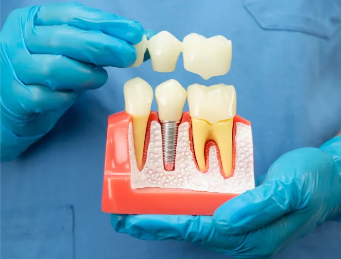 types of dental implant failure