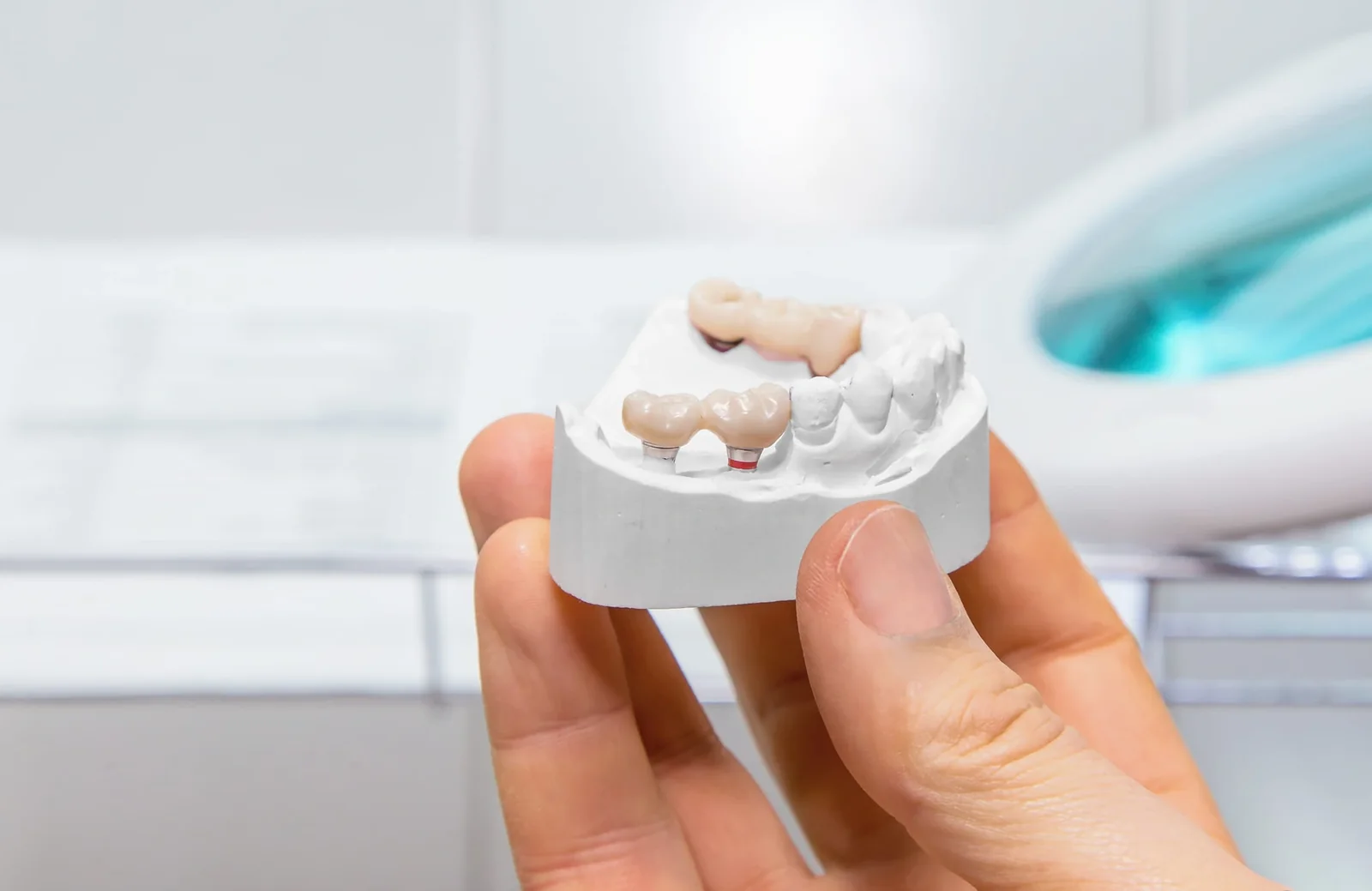 dental bridges