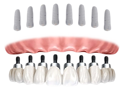 all on eight implants