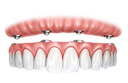 all on four implants (1)
