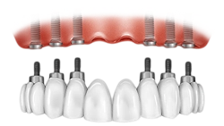 all on six implants