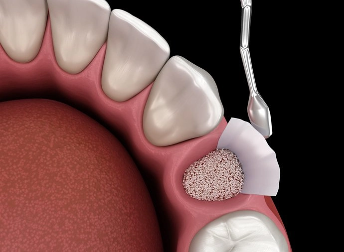 augmentation surgery adding bone after tooth extraction