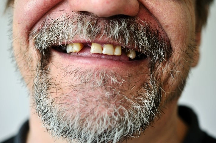 bad teeth