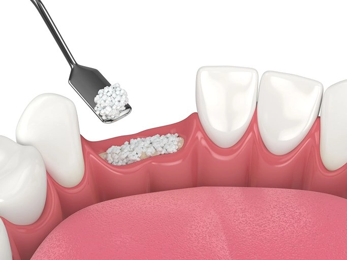 bone grafting candidate