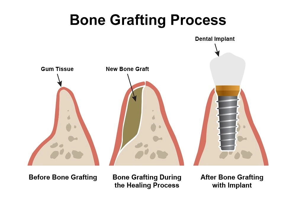 bone grafting