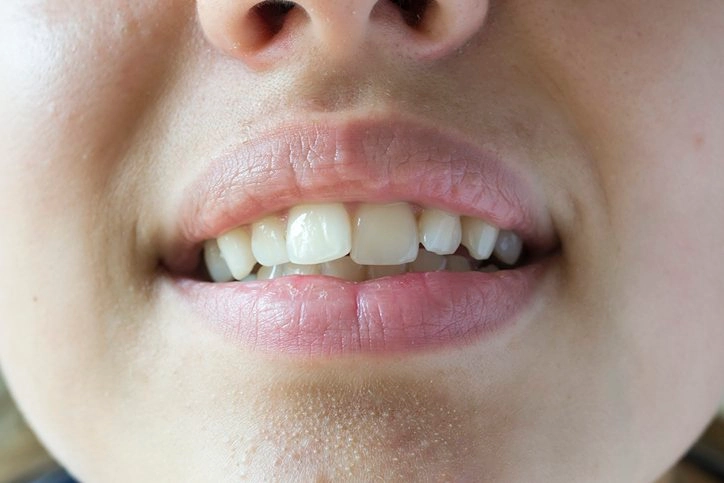 crooked teeth12
