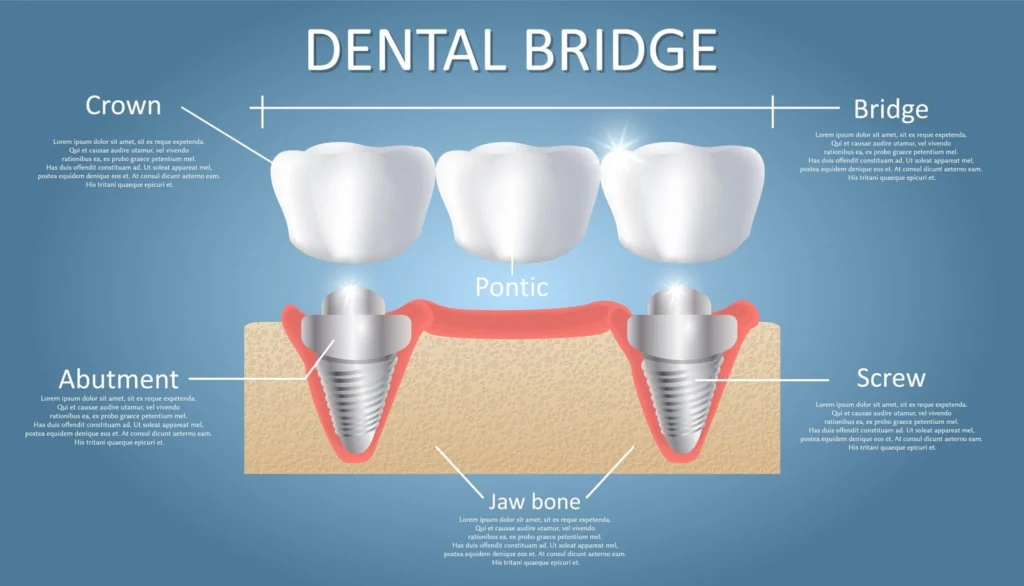 dental bridges visualisation 2048x1171