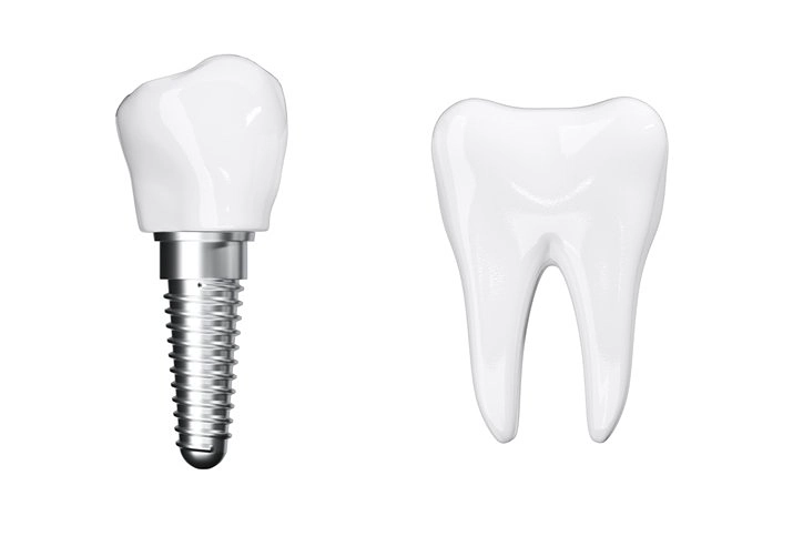 dental implant material