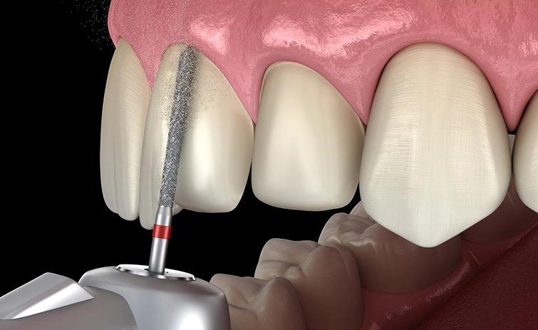 dental veneers process