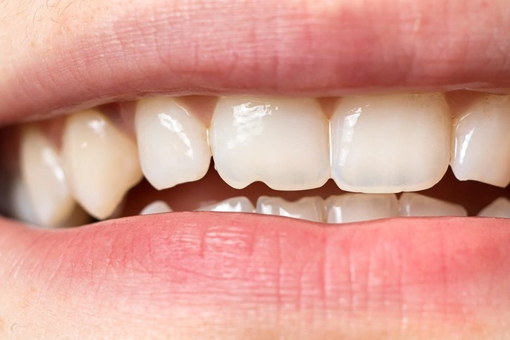 fix chipped tooth
