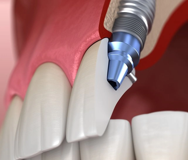 front tooth implant