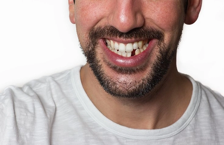 missing teeth2