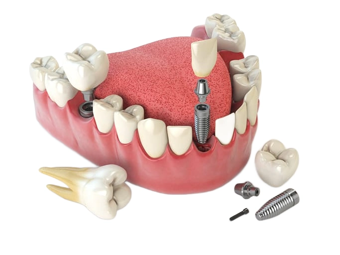 tooth implants options (1)