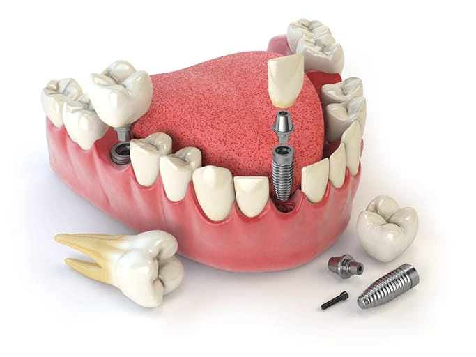 tooth implants options