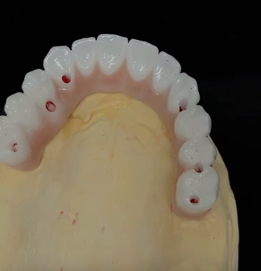 upper all on 6 zirconia denture