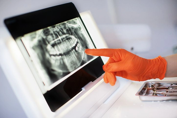 waiting too long for dental implants