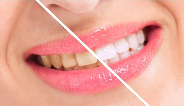 white smile